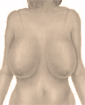Breast reduction surgery