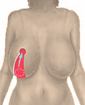 Breast reduction surgery