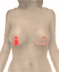 Breast reduction surgery