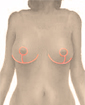 Breast reduction surgery