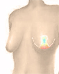 Breast uplift surgery