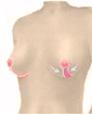 Breast uplift surgery