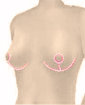 Breast uplift surgery