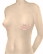 Breast uplift surgery