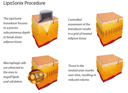Liposonix explained
