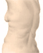 Liposuction surgery