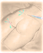 Liposuction surgery