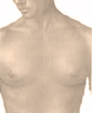 Male breast reduction surgery