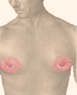 Male breast reduction surgery