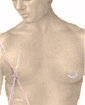 Male breast reduction surgery