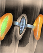 Ear correction surgery