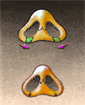 Rhinoplasty surgery