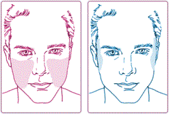 Sculptra treatment areas