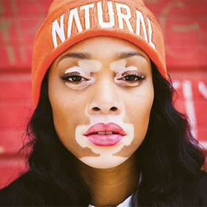 Vitiligo - Angelica comments on this often distressing skin condition
