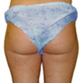 Patient before liposuction