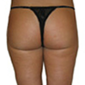 Patient after liposuction